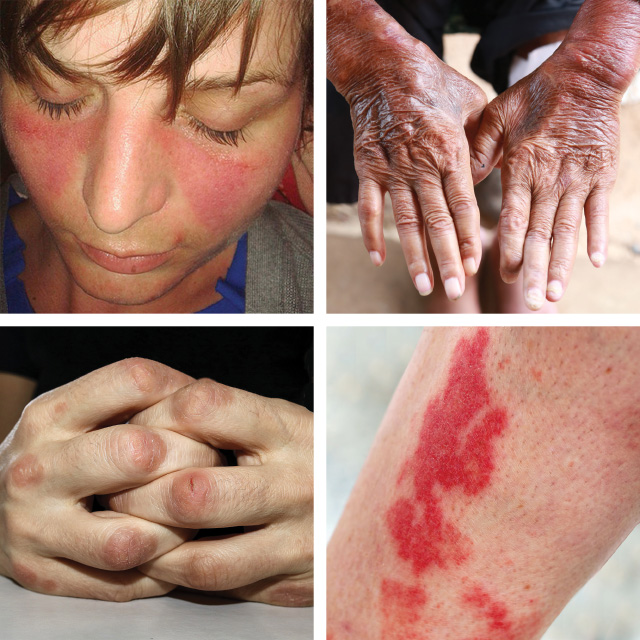 Four pictures of : Lupus, Systemic Sclerosis, Dermatomyositis, and Vasculitis.