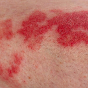Close-up for human leg with vasculitis.