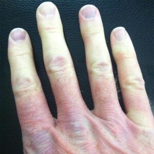 Mixed Connective Tissue Disease - Raynaud's Syndrome.